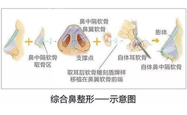 為什么都建議做鼻綜合手術(shù)？