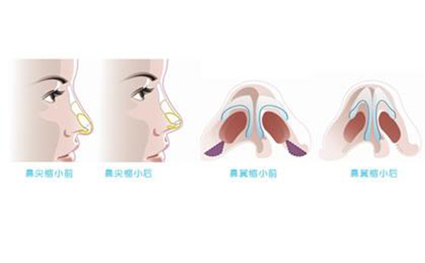 鼻翼縮小整形安全嗎？術(shù)后會不會影響呼吸