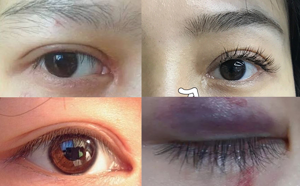 開內眼角容易留疤嗎?開內眼角危害大不大?