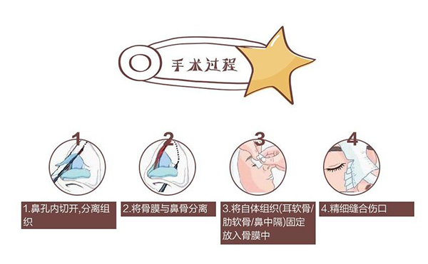 自體軟骨隆鼻為什么這么受歡迎？