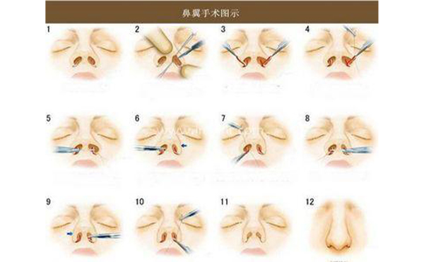 南昌愛思特做鼻翼縮小怎么樣?時(shí)間久了會(huì)不會(huì)反彈