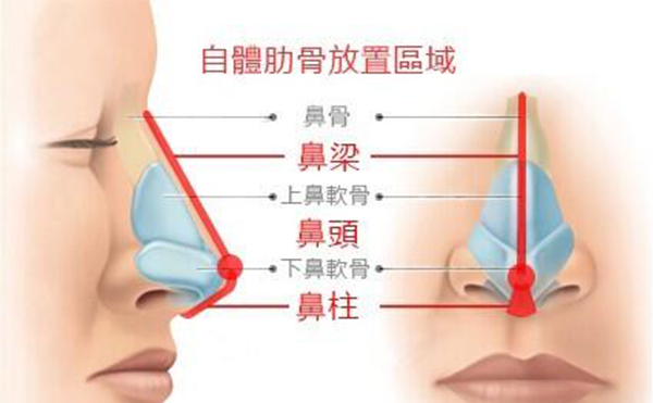 做個肋骨鼻子一般需要多少錢?全肋好還是半肋好?