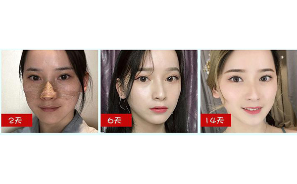 全肋鼻和半肋鼻有什么區(qū)別？做全肋好還是半肋好