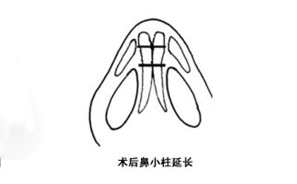 鼻小柱延長(zhǎng)可靠嗎？手術(shù)難度大嗎