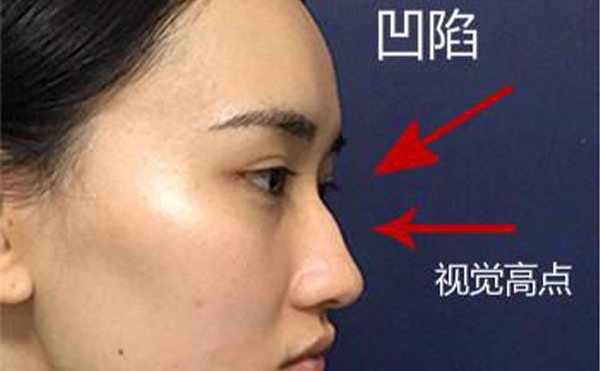 駝峰鼻整形是怎么做的？不同嚴(yán)重程度的駝峰鼻矯正方法一樣嗎？