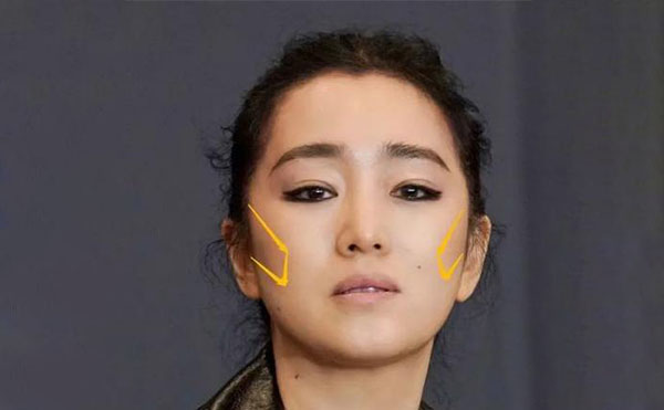 什么原因?qū)е嘛E骨外擴？
