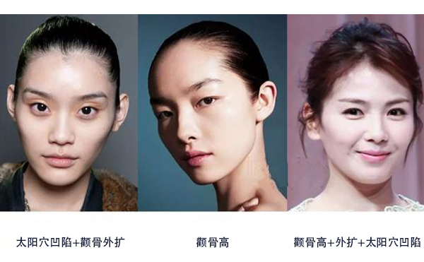 怎么區(qū)分是顴骨高還是太陽穴凹陷？