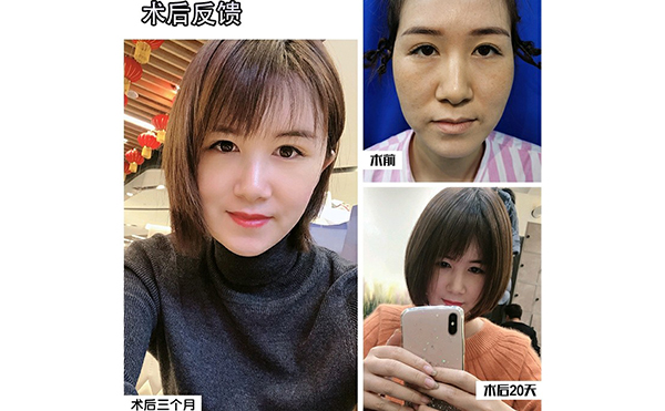 電波拉皮除皺的步驟是什么？