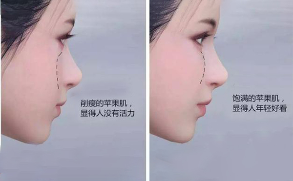 蘋果肌凹陷怎么辦？