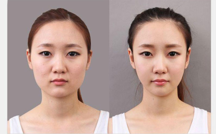 非手術(shù)瘦臉多少錢？非手術(shù)瘦臉方法有哪些？