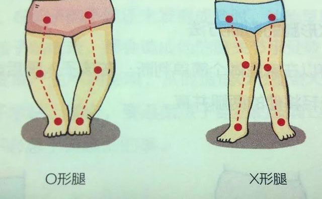 羅圈腿怎樣矯正？羅圈腿手術矯正多少錢？