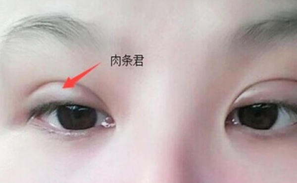 雙眼皮不自然怎么補(bǔ)救？雙眼皮肉條好修復(fù)么？