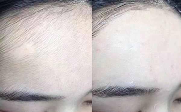 冰點面部脫毛
