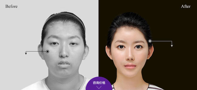 下頜角整形的方法有哪些？