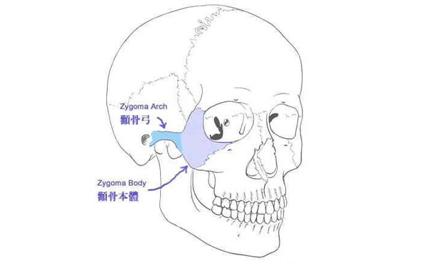什么樣的臉型需要做顴骨整形？