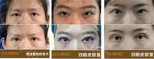 武漢卓美雙眼皮修復效果