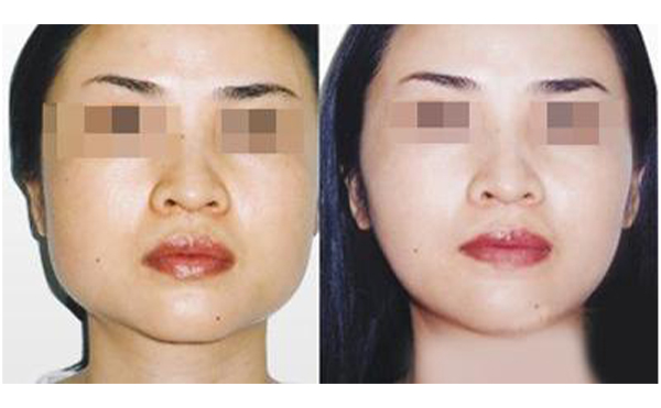 常見(jiàn)的改臉型方法有哪些?顴骨高適合做哪種改臉型手術(shù)?