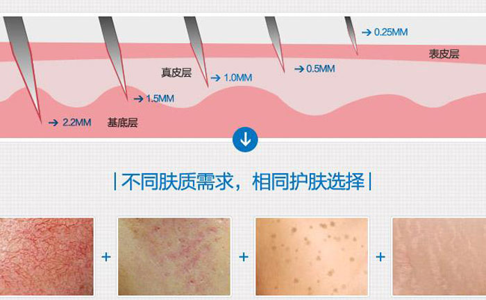 微針去痘坑多少錢一次？