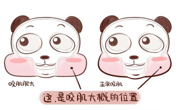 造成咬肌肥大的原因是什么？