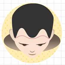 三級脫發(fā)