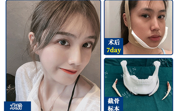 下頜角整形手術(shù)有風(fēng)險(xiǎn)嗎?有什么風(fēng)險(xiǎn)?