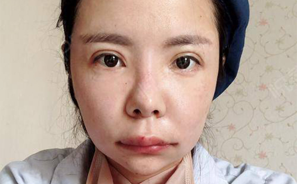 下頜角整形為什么會失敗?下頜角整容失敗如何修復(fù)?