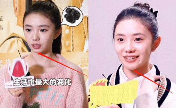 玻尿酸隆下巴整形攻略【優(yōu)勢、適宜人群、注意事項】