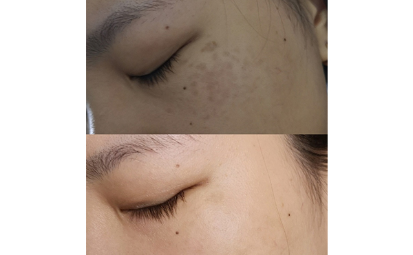 激光美白能維持多久？