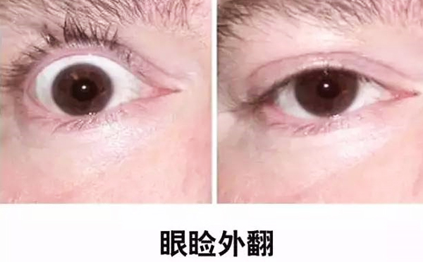 醫(yī)美技術越來越發(fā)達，不少愛美的人本著變美的心情滿懷期待地去做雙眼皮、開眼角等項目，不料整容不成、反倒毀容，后悔也來不及。有些做雙眼皮的姑娘術后出現眼瞼外翻的情況，那眼瞼外翻是什么意思?上眼瞼外翻如何修復?