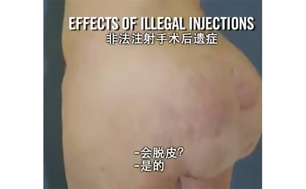 自體脂肪豐臀會(huì)留疤嗎?術(shù)后皮膚不平整怎么辦?