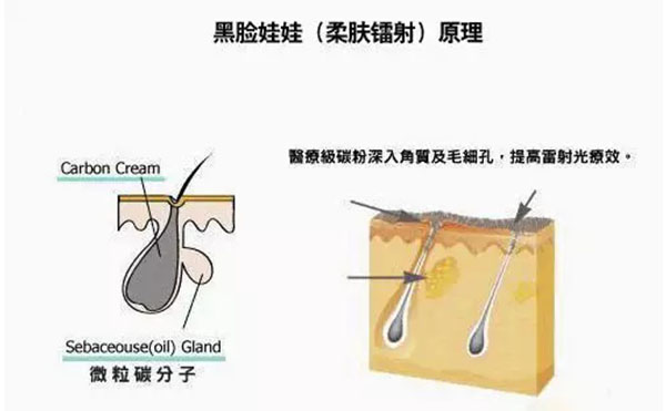 黑臉娃娃是什么？