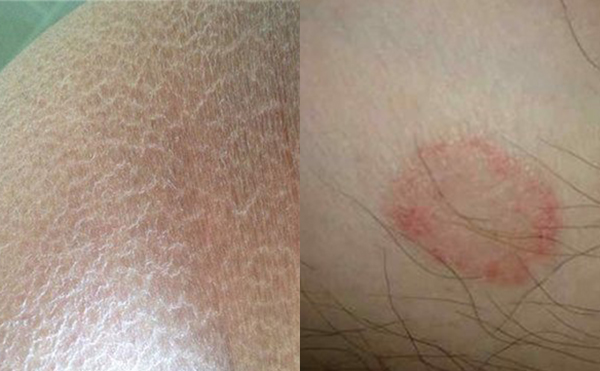 脫腋毛有什么副作用嗎？