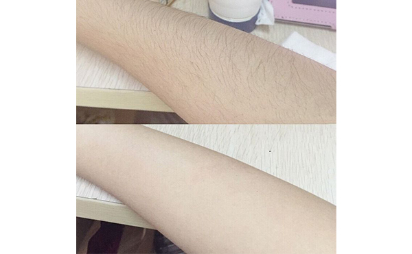 光子手臂脫毛效果怎么樣？