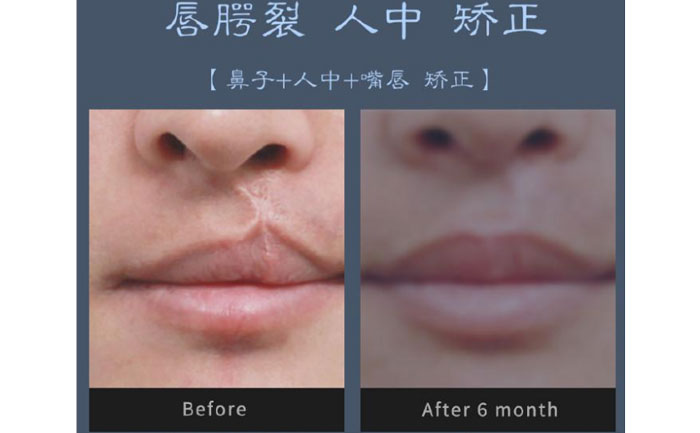 唇裂修復(fù)術(shù)需要多少錢？
