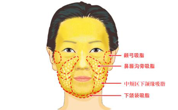 面部吸脂有哪些部位？