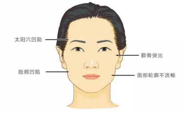 顴骨高或顴骨外擴(kuò)應(yīng)該怎么辦?