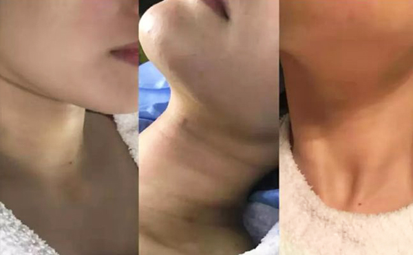 激光去頸紋多少錢？