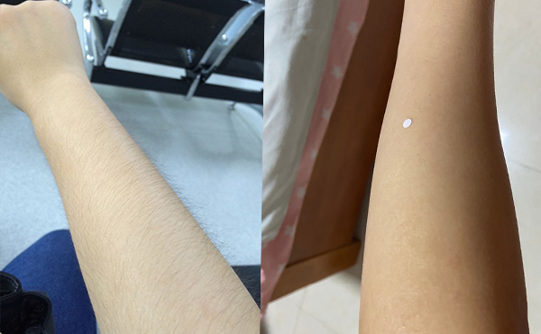 激光手臂脫毛價格貴不貴？