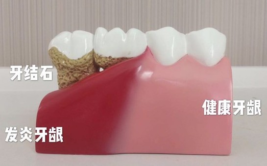 洗完牙后牙齒會變得敏感？