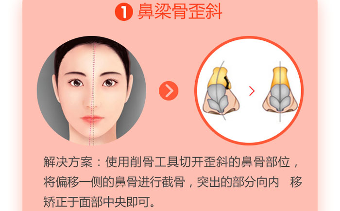 歪鼻矯正