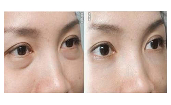吸脂去眼袋有什么優(yōu)勢？