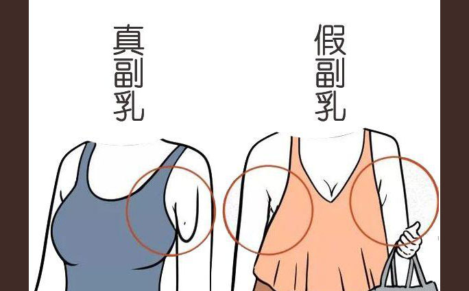 多乳癥是什么癥狀？