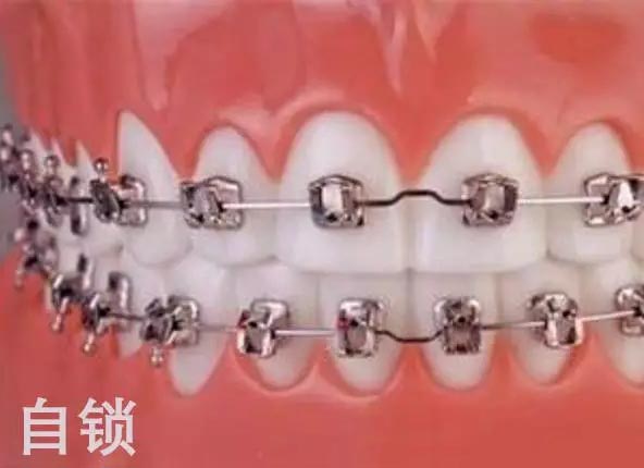 自鎖牙套