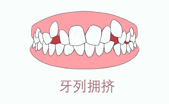矯正牙齒擁擠度怎么算？