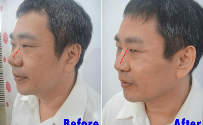 男性隆鼻子大概多少錢？