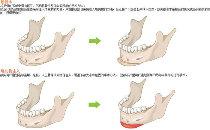 下頜角切除術(shù)一般多少錢(qián)？下頜角切除有后遺癥嗎？