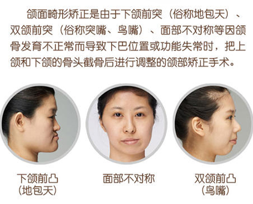正頜手術(shù)真實分享