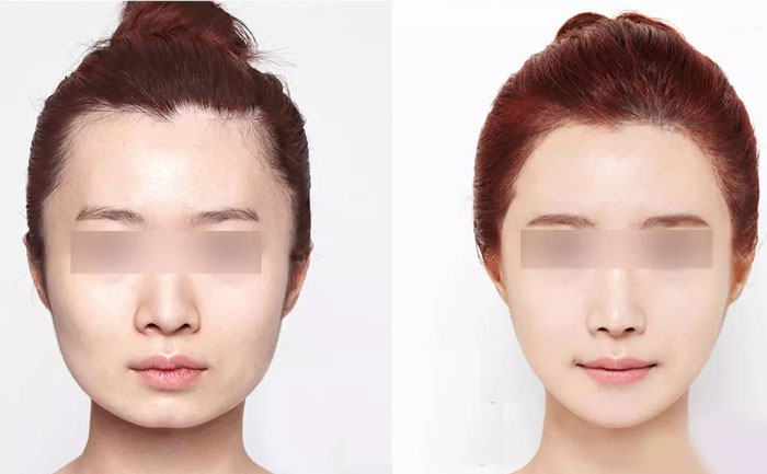 臉部咬肌肥大怎么瘦？臉部咬肌肥大如何去除？