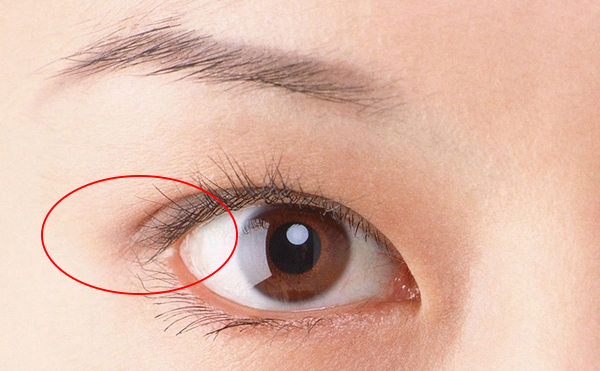開(kāi)外眼角價(jià)格多少錢(qián)?開(kāi)外眼角術(shù)后怎么護(hù)理?