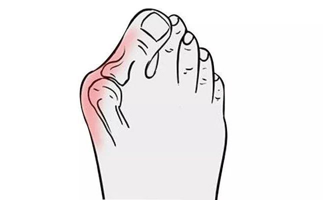 大腳骨矯正手術(shù)多少錢？大腳骨矯正三個(gè)月可以恢復(fù)嗎？